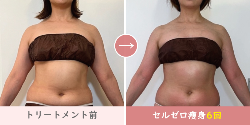 セルゼロ半身痩身結果写真、お腹痩せ施術6回｜熊本、阿蘇エステ「PRIMA」