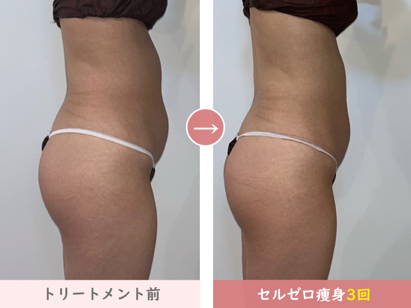 セルゼロ全身痩身結果写真、お腹痩せ施術3回｜熊本、阿蘇エステ「PRIMA」