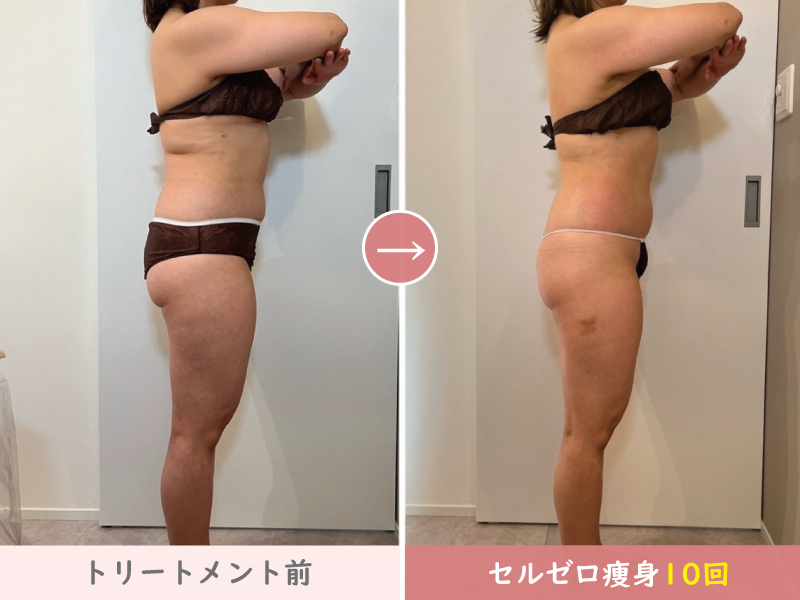 セルゼロ全身痩身結果写真、全身痩せ施術10回｜熊本、阿蘇エステ「PRIMA」