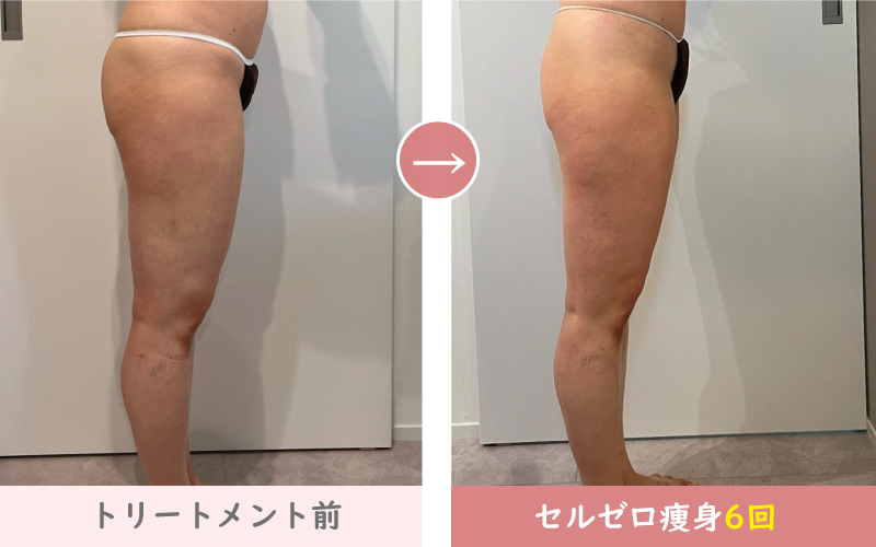 セルゼロ半身痩身結果写真、足痩せ施術6回｜熊本、阿蘇エステ「PRIMA」