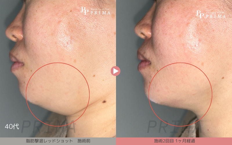 プラズマEMS×脂肪溶解【レッドショット】施術写真|熊本、阿蘇、大津町エステ「PRIMA」プリマ、レッドショット結果写真1枚目、40代、フェイスライン結果写真2回目