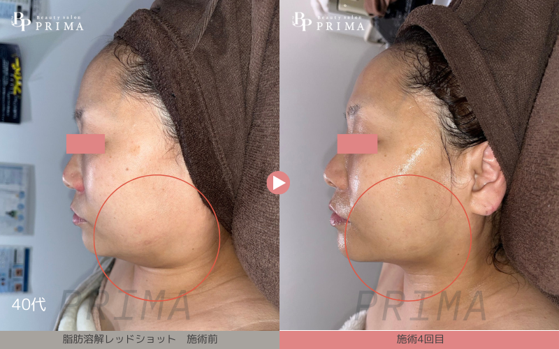 プラズマEMS×脂肪溶解【レッドショット】施術写真|熊本、阿蘇、大津町エステ「PRIMA」プリマ、レッドショット結果写真2枚目、40代、二重あご改善4回目結果写真、