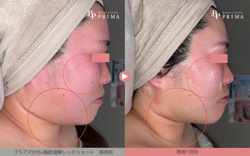 プラズマEMS×脂肪溶解【レッドショット】施術写真|熊本、阿蘇、大津町エステ「PRIMA」プリマ、レッドショット結果写真3枚目、30代、フェイスラインのたるみ改善1回目結果写真。