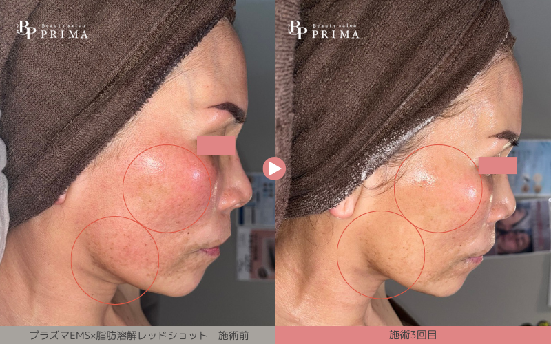 プラズマEMS×脂肪溶解【レッドショット】施術写真|熊本、阿蘇、大津町エステ「PRIMA」プリマ、レッドショット結果写真4枚目、30代、3回目、フェイスライン